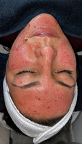 Dermapen Behandeling